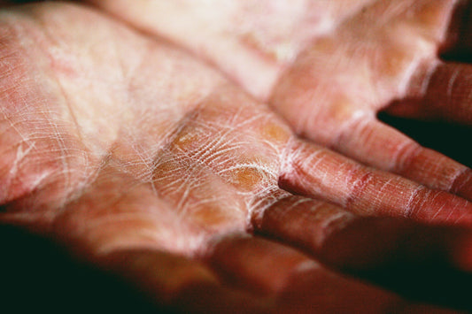 How to Treat Dry Skin with Body Lotion?